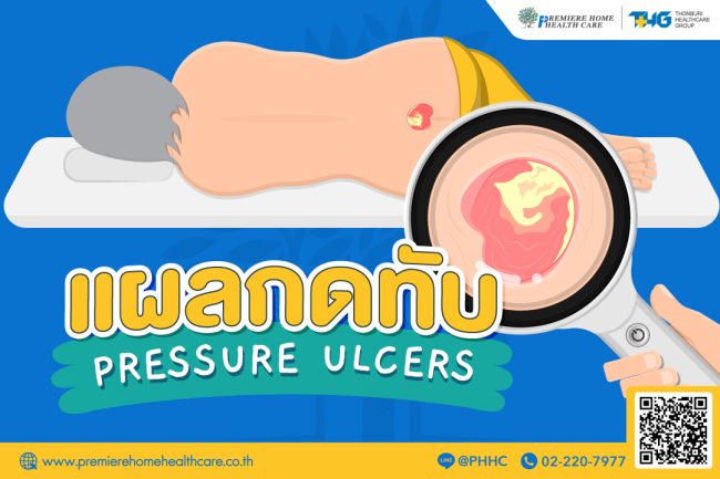 แผลกดทับ