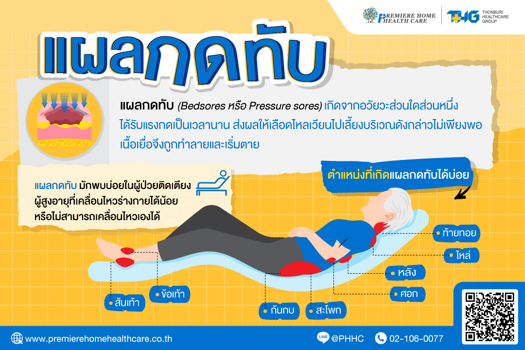 แผลกดทับ
